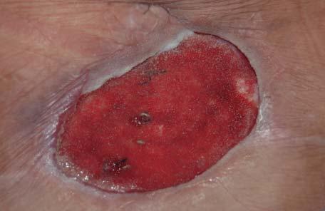 inferior portion of the TRAM and mastectomy flaps. Two days after debridement, a wound VAC was placed on these debridement areas.