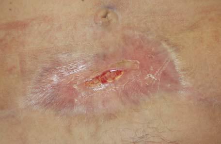 A split-thickness skin graft for wound coverage was planned; however, the patient became too ill to undergo surgery.