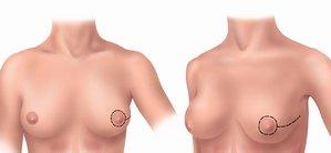 DIEP/TRAM Abdomen and breast