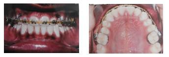 After closure of the spacing in the maxillary anterior region a frenectomy procedure was performed for thick maxillary labial frenum.