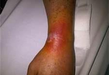 Phlebitis indicates irritation and/or inflammation to the vein Clinical presentation Pain