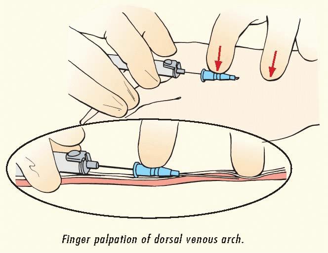10.Upon flashback visualization, lower the catheter almost parallel to the skin. 11.