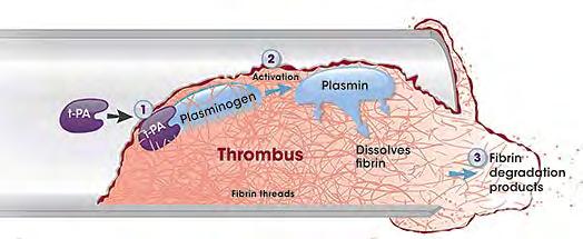 Mechanism of Action of Thrombolytics 2 Converts entrapped plasminogen to plasmin 1 Recombinant tpa binds to fibrin