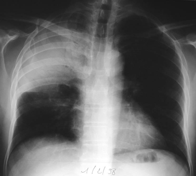 Young man with no medical history Fever, chills, sudden onset with right chest pain and purulent sputum Right upper lobe pneumonia