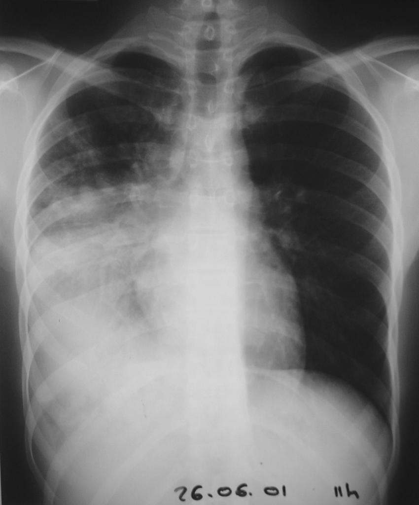 Man, 35 years old, dyspnea and severe