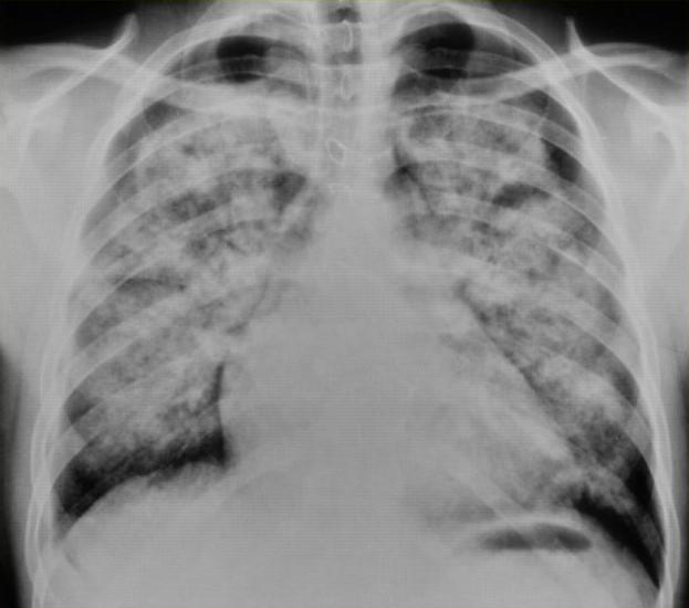 Acute pulmonary oedema
