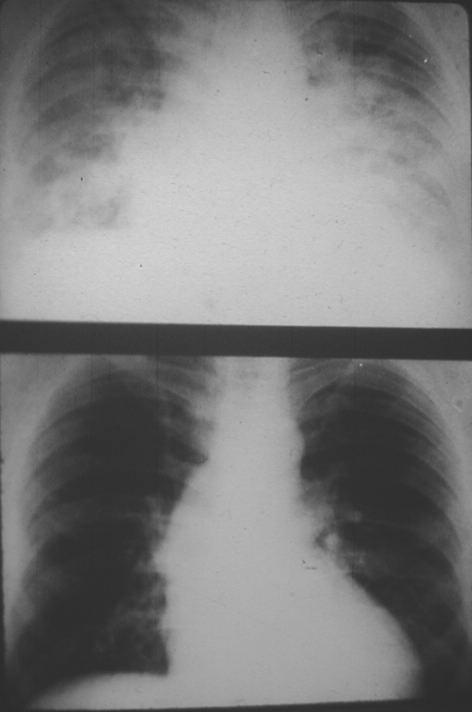 Acute pulmonary