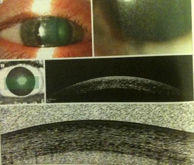 Anterior segment SD-OCT of a patient with ocular cystinosis shows hyperreflective deposits in the stroma and