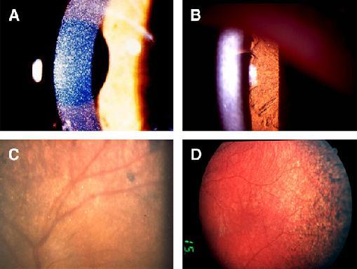 Ophthalmic manifestations of infantile nephropathic cystinosis: corneal crystals (A), iris crystals (B), retinal crystals (C ), peripheral retinal pigmentary changes (D) Tsilou E, Zhou M, Gahl