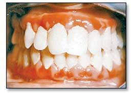 Introduction Plasma cell gingivitis (PCG) is a rare condition characterized by diffuse and massive infiltration of plasma cells into the sub-epithelial gingival tissue.