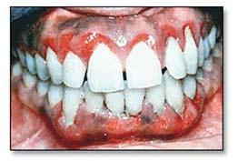 No other swelling, ulcers, or masses were noted on the lips, tongue, palate, buccal mucosa, or the floor of the mouth. Hematologic evaluation showed no abnormal findings.