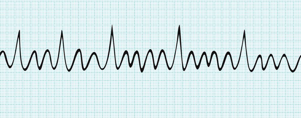 How is atrial fibrillation diagnosed? If your GP suspects you have atrial fibrillation, he or she will probably refer you to a heart specialist for further tests.