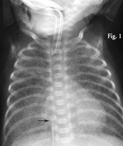 what appears to be bilateral pneumothoraces.