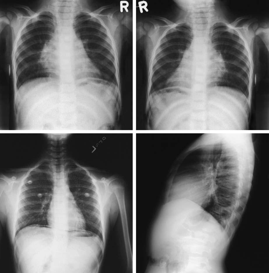 26 3 Chest Exmintions in Children c Fig. 3.12. Cn you find the normlity? (Look t the films; then red on) Film of 12-month-old oy. No, the film is not leled incorrectly.