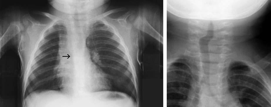 Chest (Airwy, Medistinum, Diphrgm, Lungs) 35 Fig. 3.25. A 6-month-old infnt with cough Frontl rdiogrph shows the crin pushed to the left. There is ulge on the right side of the irwy.