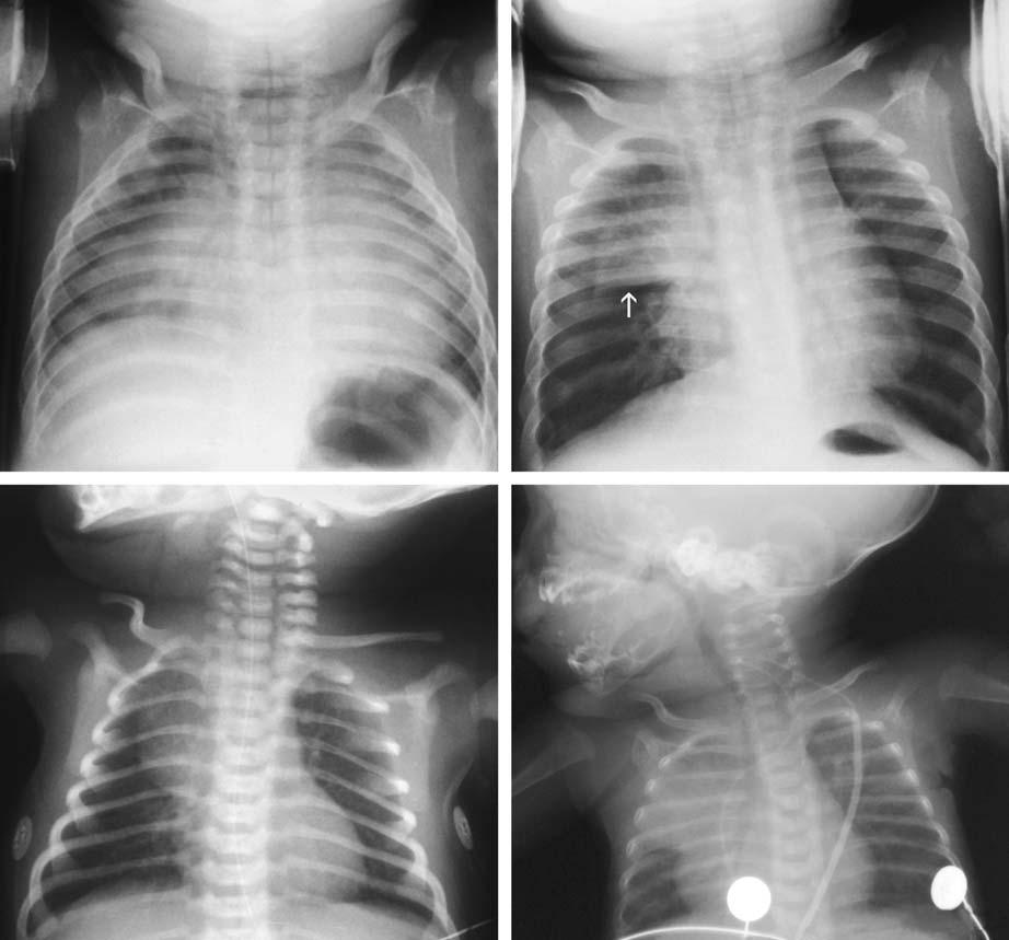 Chest (Airwy, Medistinum, Diphrgm, Lungs) 37 c Fig. 3.27. Thymus Frontl rdiogrph shows ll the prmeters of film tken during expirtion.