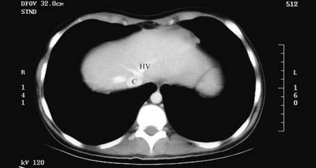 The left suclvin rtery is seen (rrow) A next lower section shows the ortic rch on the left side (A) c Proceeding inferiorly, the descending ort (D) is noted.