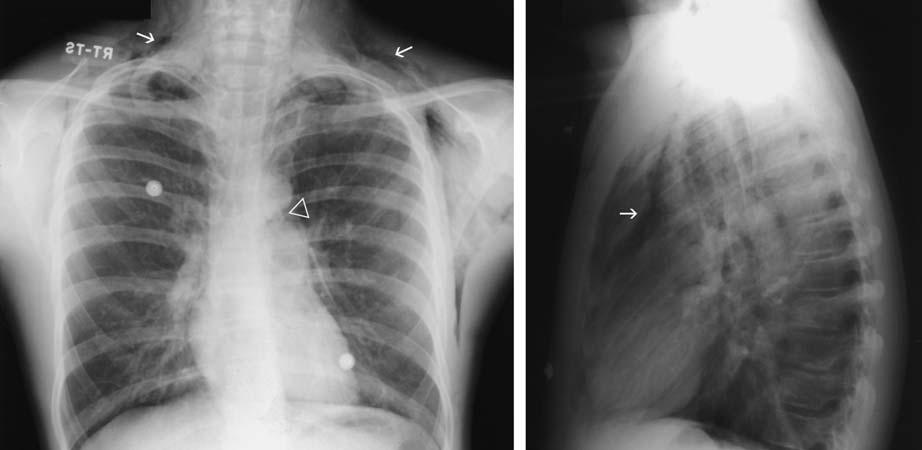 Chest (Airwy, Medistinum, Diphrgm, Lungs) 41 Fig. 3.30. Medistinl nd pericrdil ir Frontl exmintion shows ir (lck) in oth shoulders (rrows), xill, chest wll, nd in the medistinum.