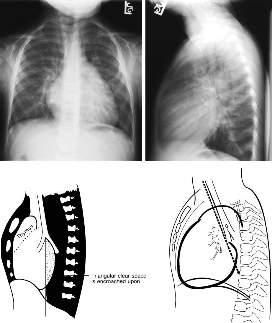 42 3 Chest Exmintions in Children c d Fig. 3.31. Evlution of crdic enlrgement on lterl film Frontl view of the chest shows the hert to e enlrged. There re indistinct vessels.