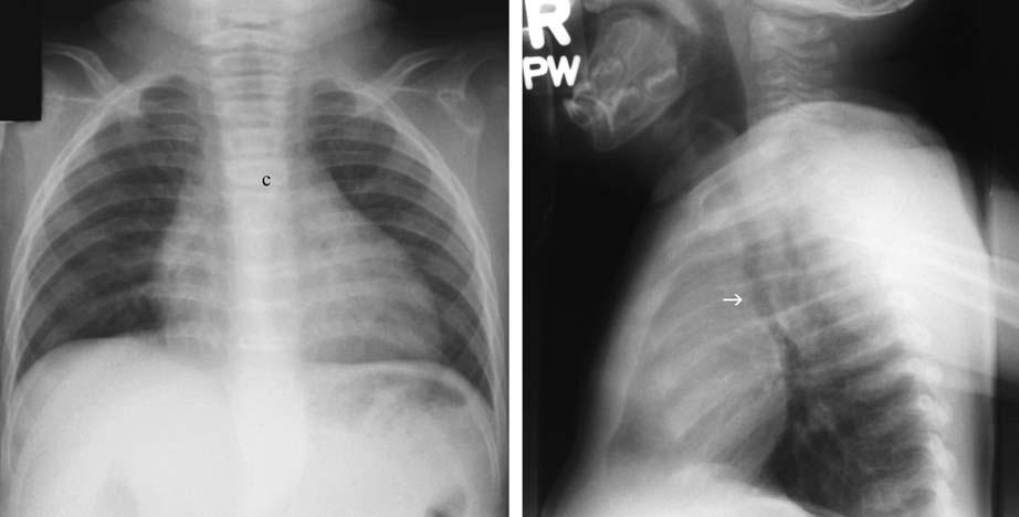 46 3 Chest Exmintions in Children e f g Fig. 3.34 e g (continued) e Another child with doule ortic rch.