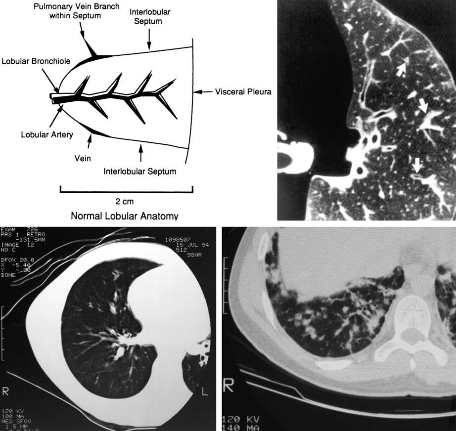50 3 Chest Exmintions in Children c d Fig. 3.39. High-resolution CT.