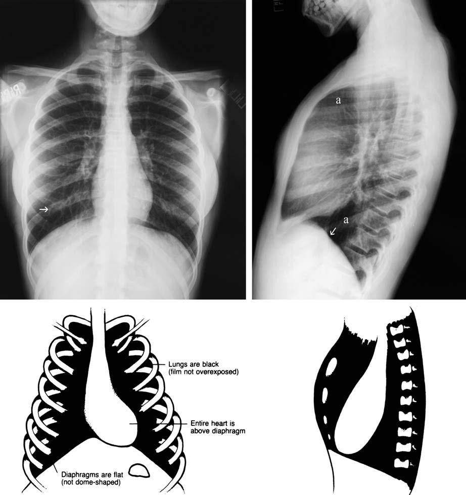 18 3 Chest Exmintions in Children c Fig. 3.3. Hyperexpnded chest rdiogrph Frontl view.