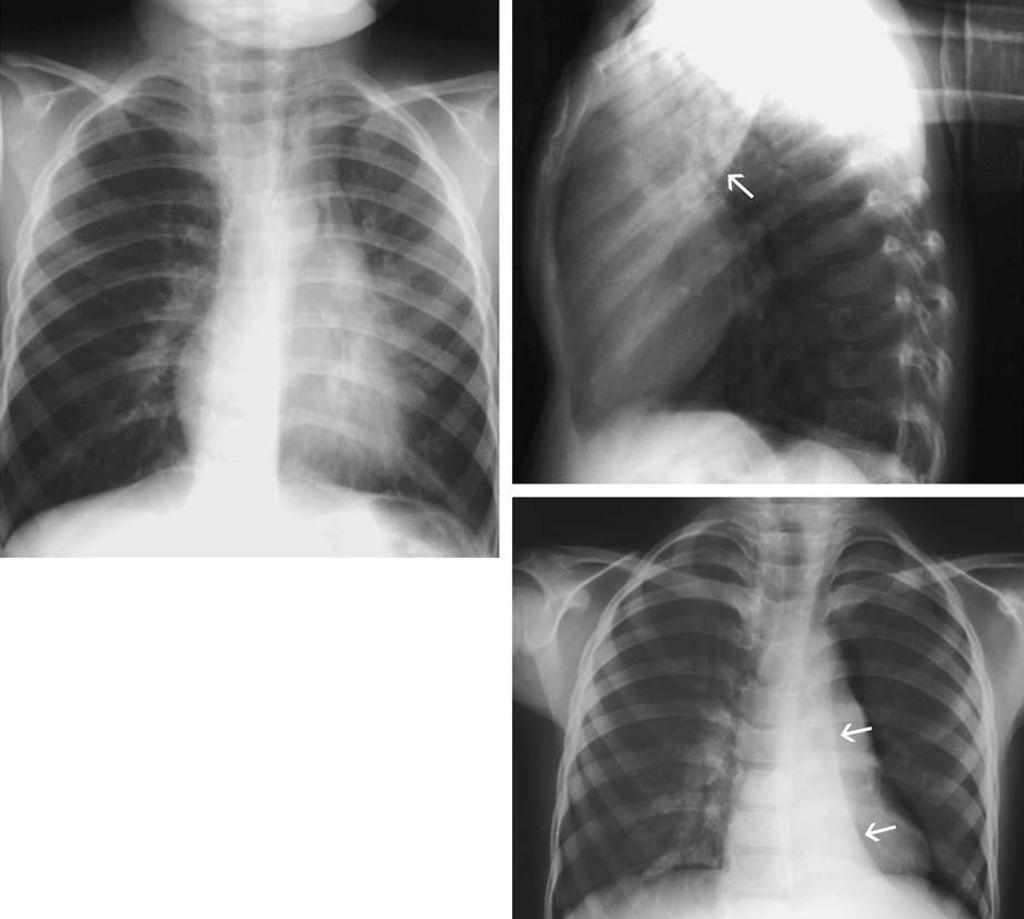 54 3 Chest Exmintions in Children g f Fig. 3.42 (continued) f, g Left upper loe collpse. Note tht the hert mrgin is quite irregulr nd not well seen.