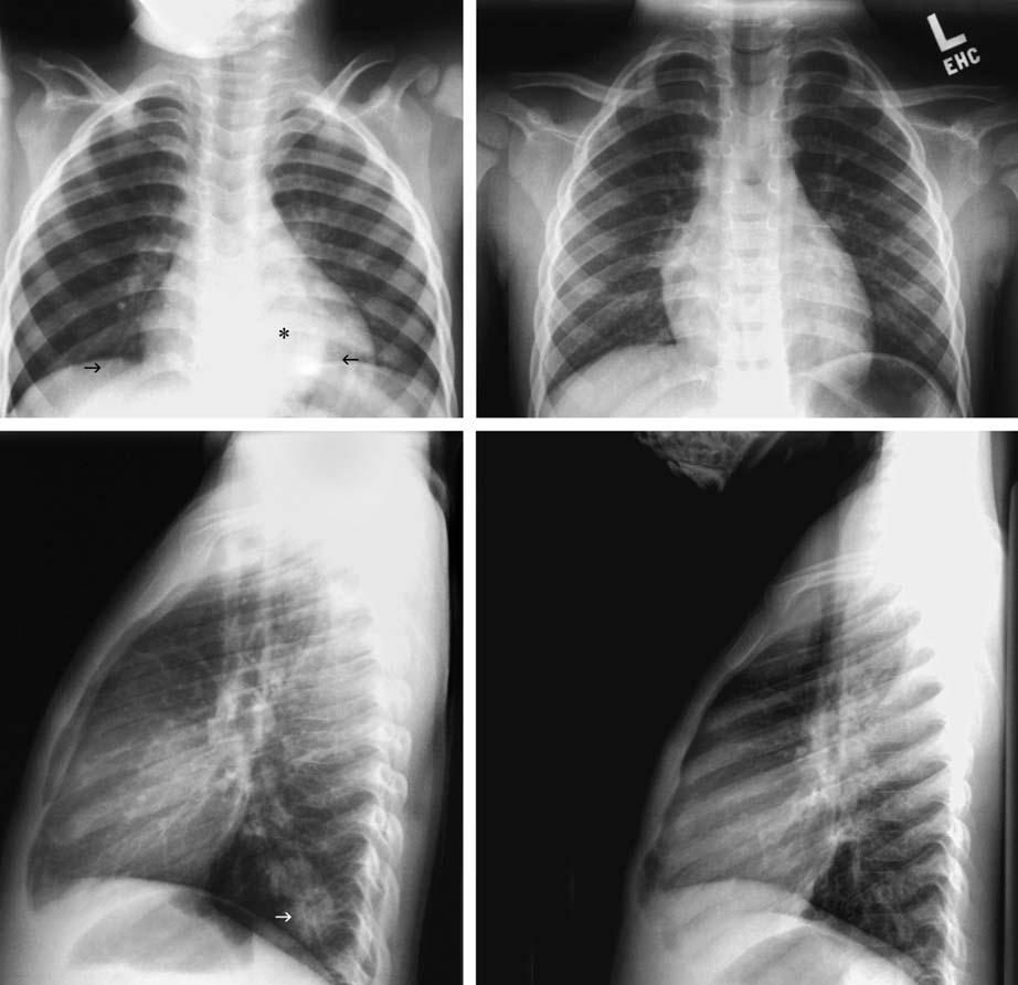 Chnge in Pulmonry Densities 55 c Fig. 3.43. The hert nd liver re trnsprent orgns A 2-yer-old with fever nd cough.