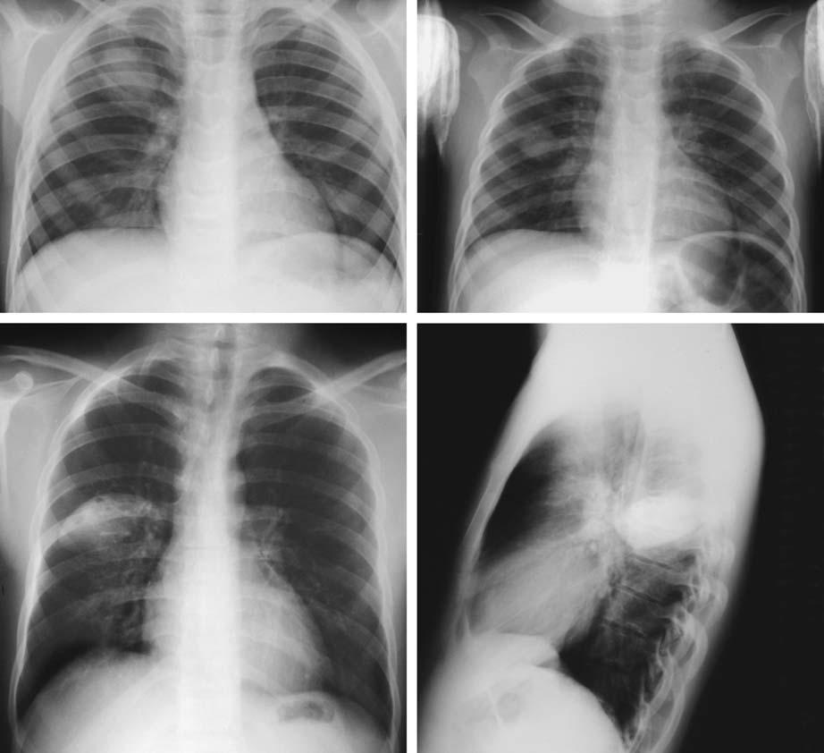 56 3 Chest Exmintions in Children c d Fig. 3.44. Unusul pulmonry opcities Round pneumoni.