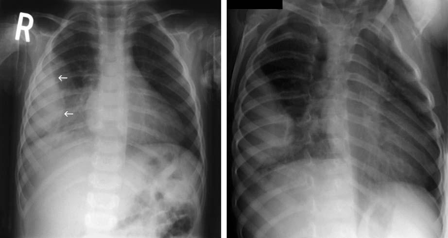60 3 Chest Exmintions in Children c Fig. 3.49. Empyem Chest rdiogrph in this 32-month-old with fever nd respirtory signs revels lrge right opcity with convex ppernce towrd the lung (rrows).