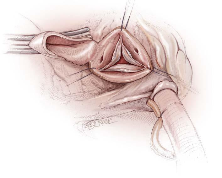 External Exposure Aortotomy is performed 1 cm above the sinotubular junction
