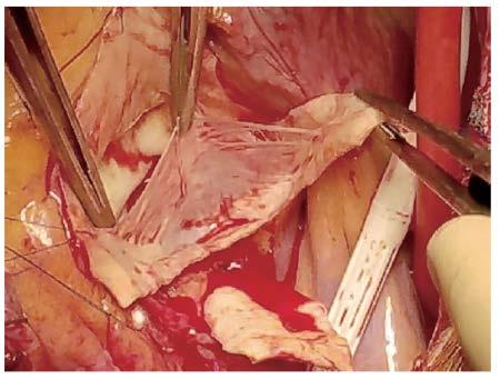 salvageable Fenestration of aortic