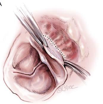 Root Preparation/Dissection Limit of dissection right coronary sinus and N/R commissure Anatomic limit of dissection Muscular