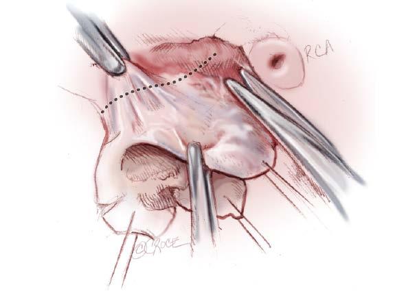 Root Preparation/Dissection Anatomical limit of dissection is roof of left atrium (left sinus) and