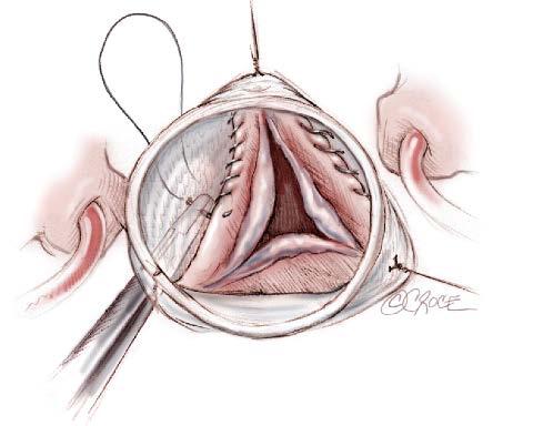 Valve Reimplantation Begin with commissures: 4-0 polypropylene suture Running