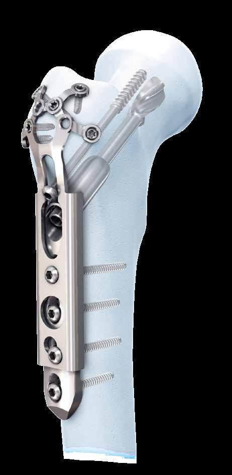 FEMORAL NECK FRACTURES UNIVERSAL LOCKING TROCHANTERIC STABILIZATION DEVICE (ULTSP) For use with DCS/DHS and LCCP DHS Prevents rotation