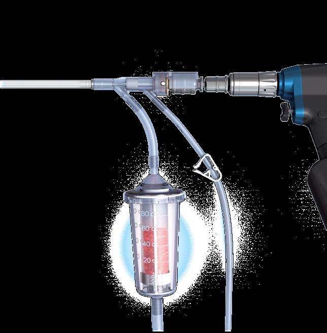 PROXIMAL FEMUR FRACTURES REAMER IRRIGATOR ASPIRATOR Single pass reaming with reduced complication Allows for harvesting autogenous