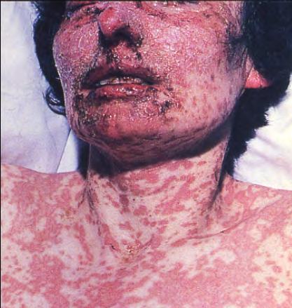 Toxic Epidermal Necrolysis Fever, systemic toxicity, skin painful, Nikolsky s sign