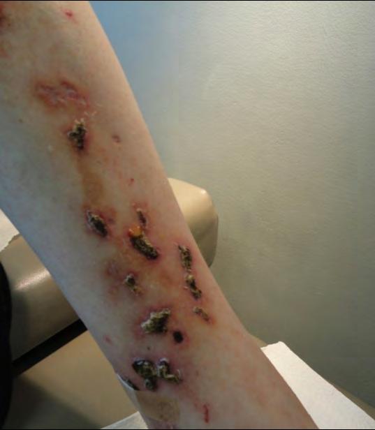 Vasculitis Atypical ulcerations, necrosis, livedo