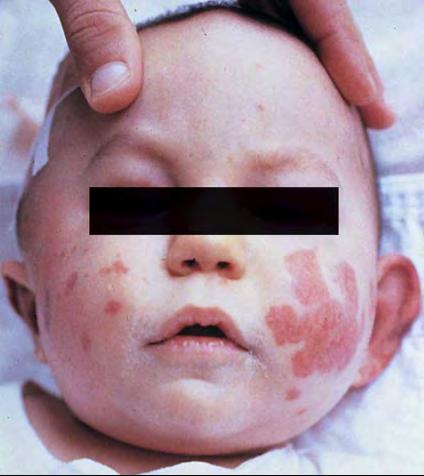 Henoch Schonlein Purpura Children 3-7 yrs Post upper resp tract illness Petechiae coalesce, buttock, legs Young children facial swelling