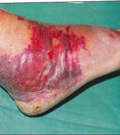 Post infectious purpura fulminans PF lesions appear a few days or weeks after a febrile illness Lower body,