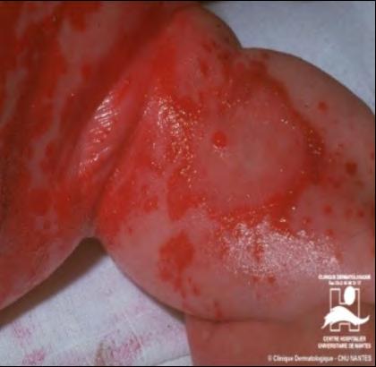 Staphylococcal Scalded Skin Syndrome Less