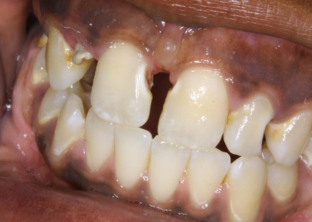 Cavitated Lesions Early tooth decay