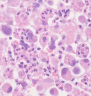 Giant Cell Carcinoma Lung Rare subtype of non small cell carcinoma <1% of all lung cancers, > male (5:1)