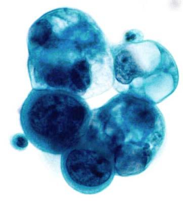 adenocarcinoma cells, severe nuclear