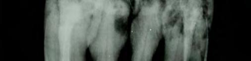 Figure 3. Dorsoventral radiographic projection of the premaxillae of a 25-year-old horse affected with severe periodontal disease of the incisors.