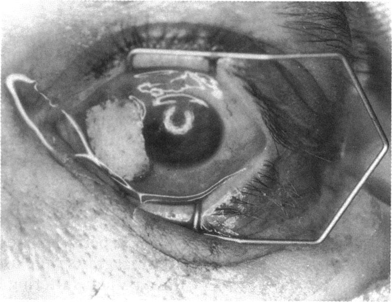 In all cases the conjunctiva at the periphery of the defect was undermined for 3-4 mm.