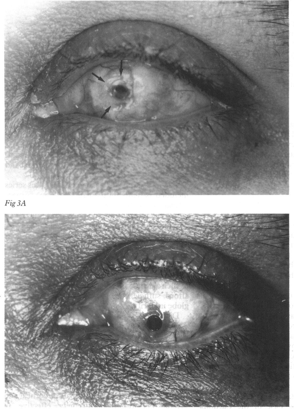 CASE 3 Following multiple retinal detachment operations, a 68-year-old female developed an enlarging equatorial staphyloma in the left eye which extended anteriorly from the corneal limbus from the
