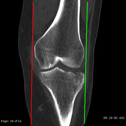 knee If a patient presents with either a partial
