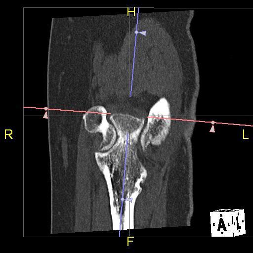 arthrogram CT scan 1 AP scout from distal